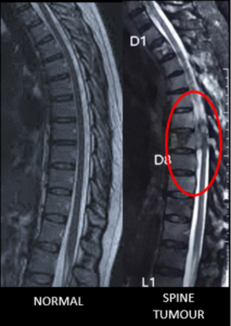 Spine Tumor